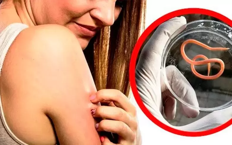 nieze un kairinājums, ko izraisa parazīti organismā