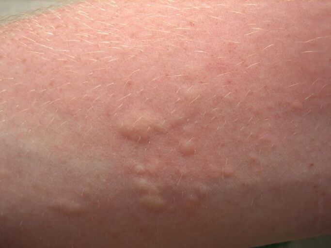 niezoši alerģiski izsitumi uz ādas var būt askaridozes simptomi